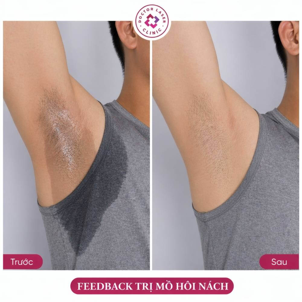 feedback trị mồ hôi nách nam