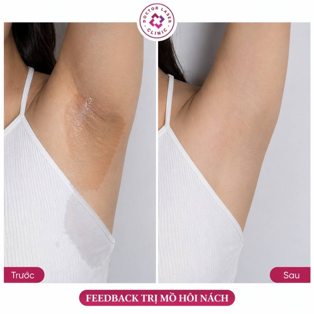 feedback trị mồ hôi nách