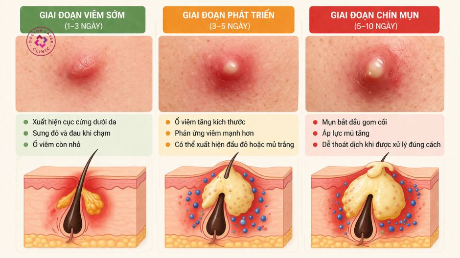 giai đoạn mụn chín