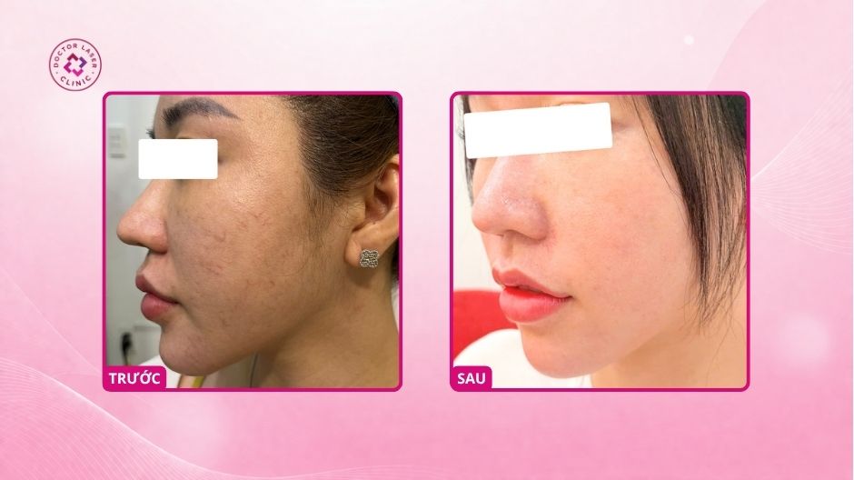 giãn mao mạch trước sau điều trị