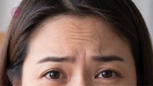 giới hạn số lần tiêm botox trong năm an toàn cơ mặt