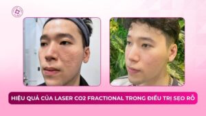 hiệu quả của laser co2 fractional trong điều trị sẹo rỗ
