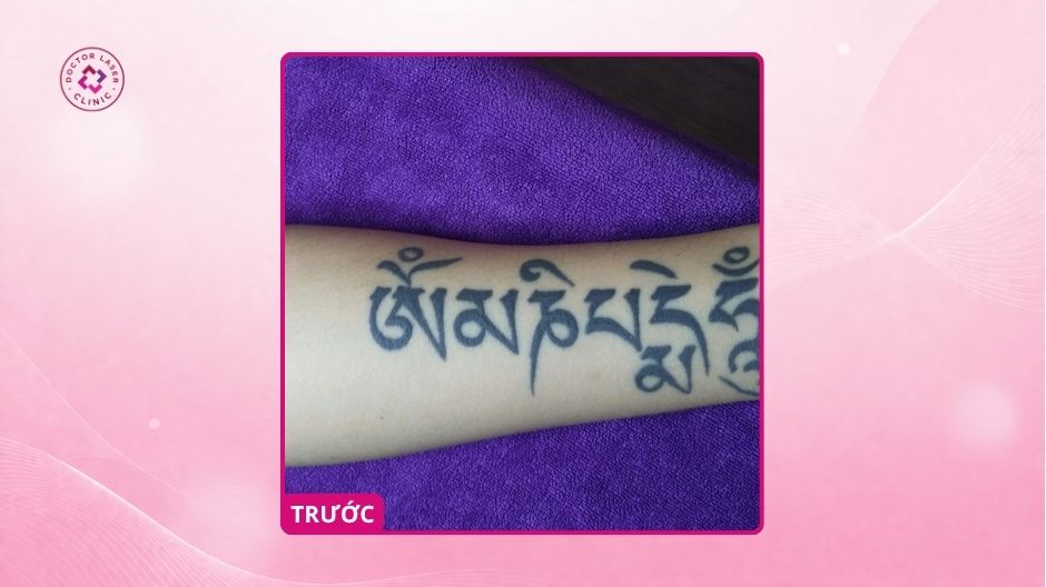 hình xăm đậm màu ở cánh tay trước khi xoá