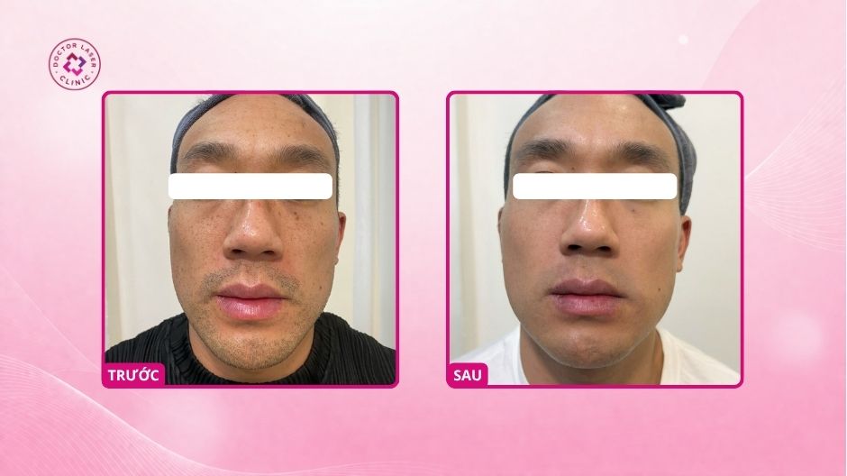 kết quả giảm nám đốm nâu sau laser pico