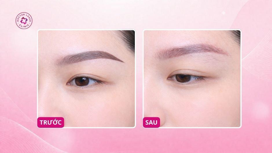 kết quả xoá xăm chân mày