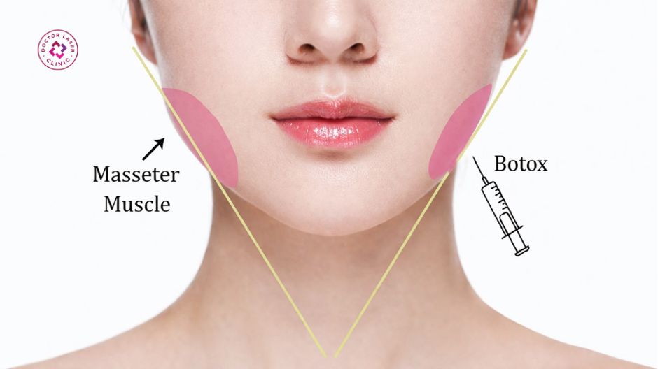 kích thước cơ cắn masseter muscle ảnh hưởng liều botox