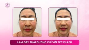 làm đầy thái dương chỉ với 2cc filler