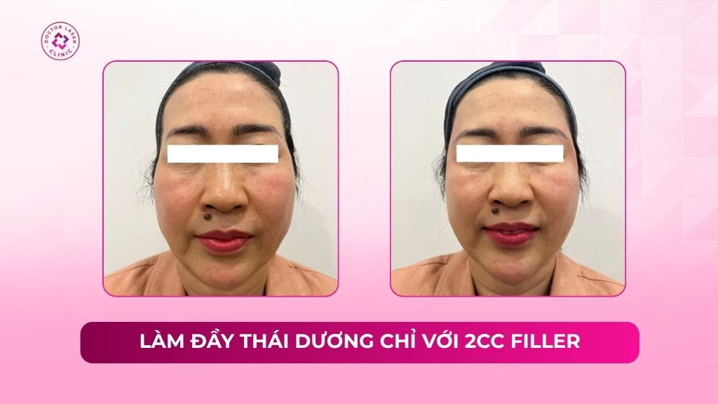 làm đầy thái dương chỉ với 2cc filler