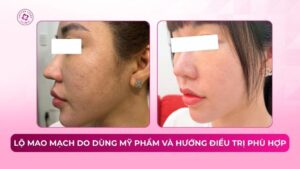 lộ mao mạch do dùng mỹ phẩm và hướng điều trị phù hợp