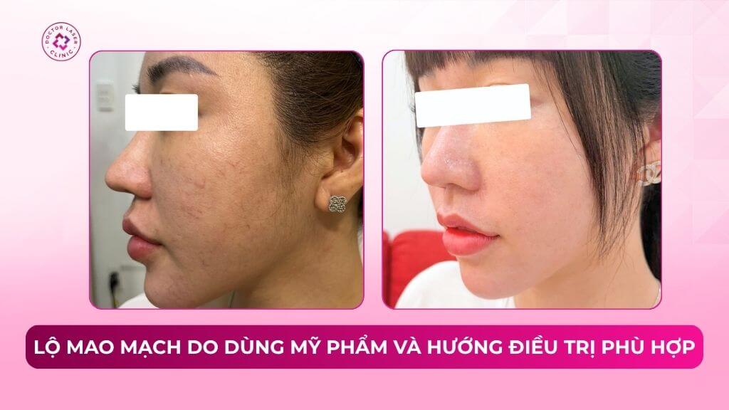 lộ mao mạch do dùng mỹ phẩm và hướng điều trị phù hợp