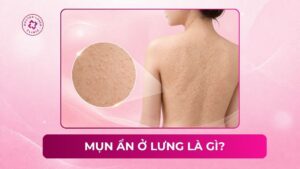 mụn ẩn ở lưng là gì