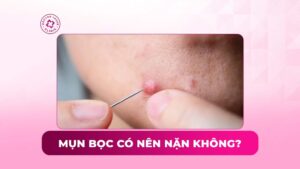 mụn bọc có nên nặn không