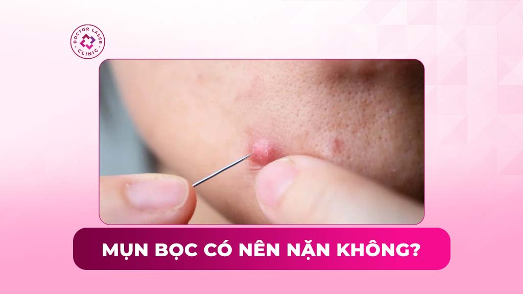 Mụn bọc có nên nặn không? Cách xử lý an toàn tránh để lại sẹo