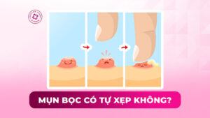 mụn bọc có tự xẹp không