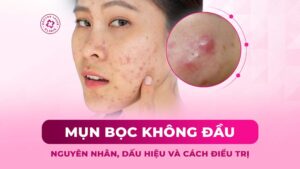 mụn bọc không đầu