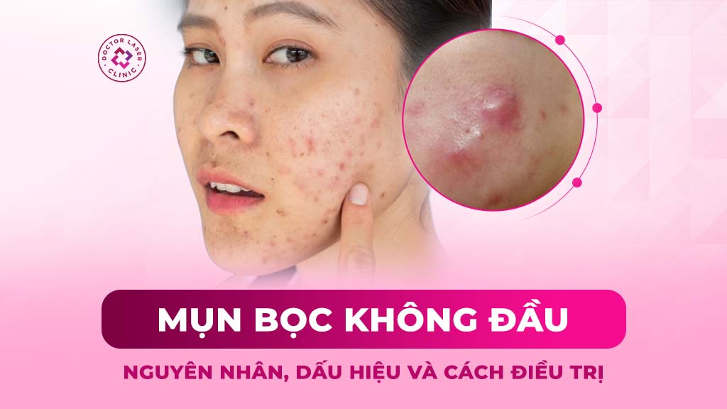 Mụn bọc không đầu (nhân): Nguyên nhân, dấu hiệu và cách điều trị