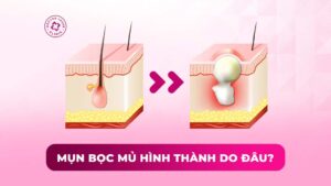 mụn bọc mủ hình thành do đâu