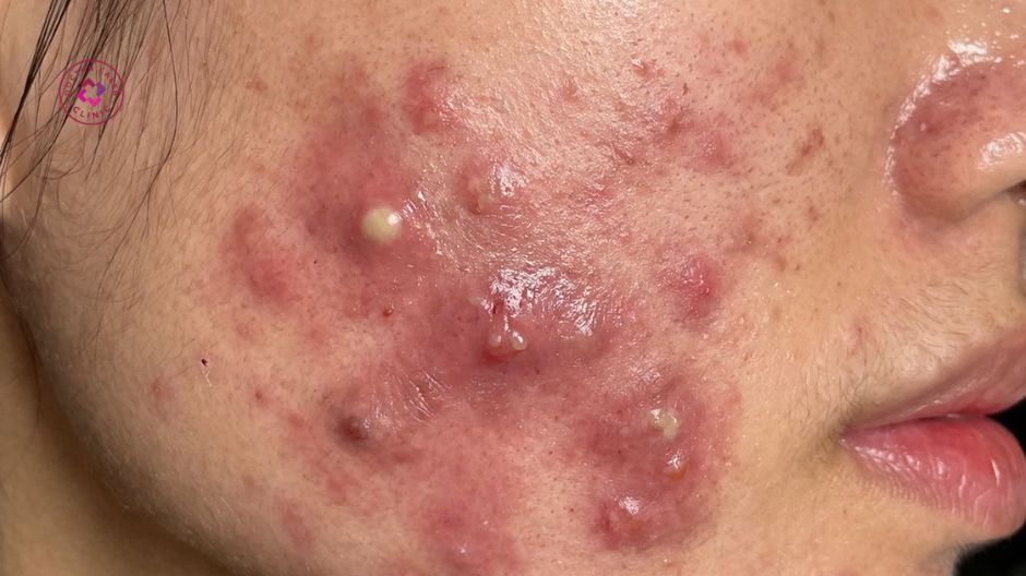 mụn bọc mủ viêm nặng