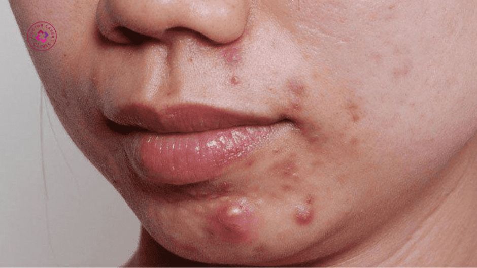 mụn bọc mụn viêm nặng