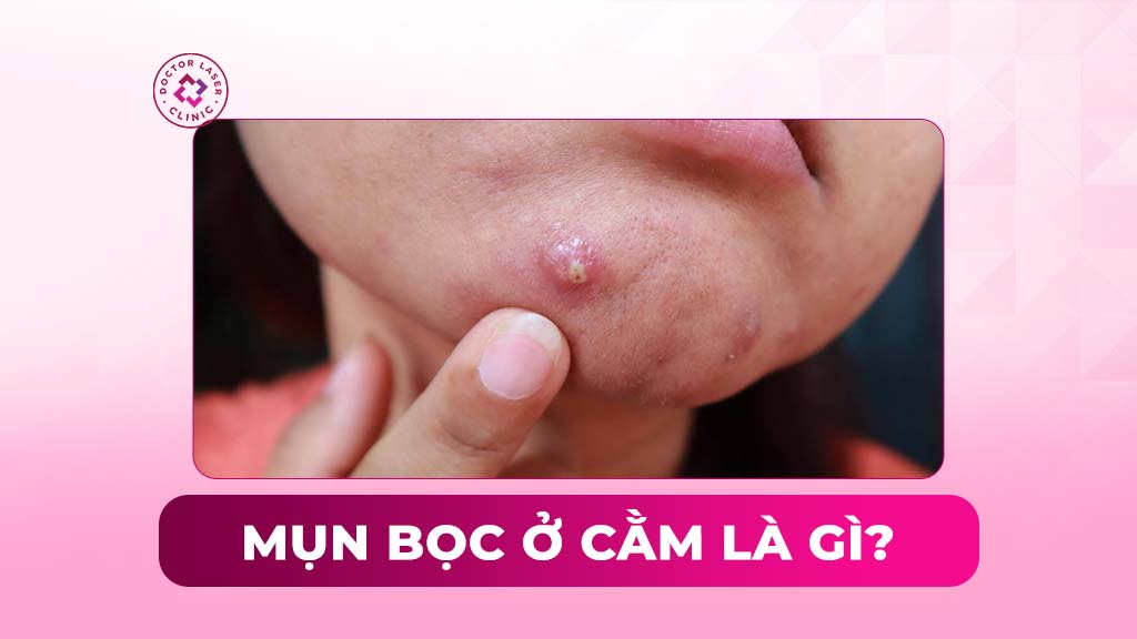 Mụn bọc ở cằm: Nguyên nhân, dấu hiệu và cách điều trị