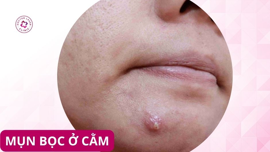 Mụn bọc ở cằm sưng đỏ kích thước lớn, viêm sâu dưới da gây đau khi chạm vào