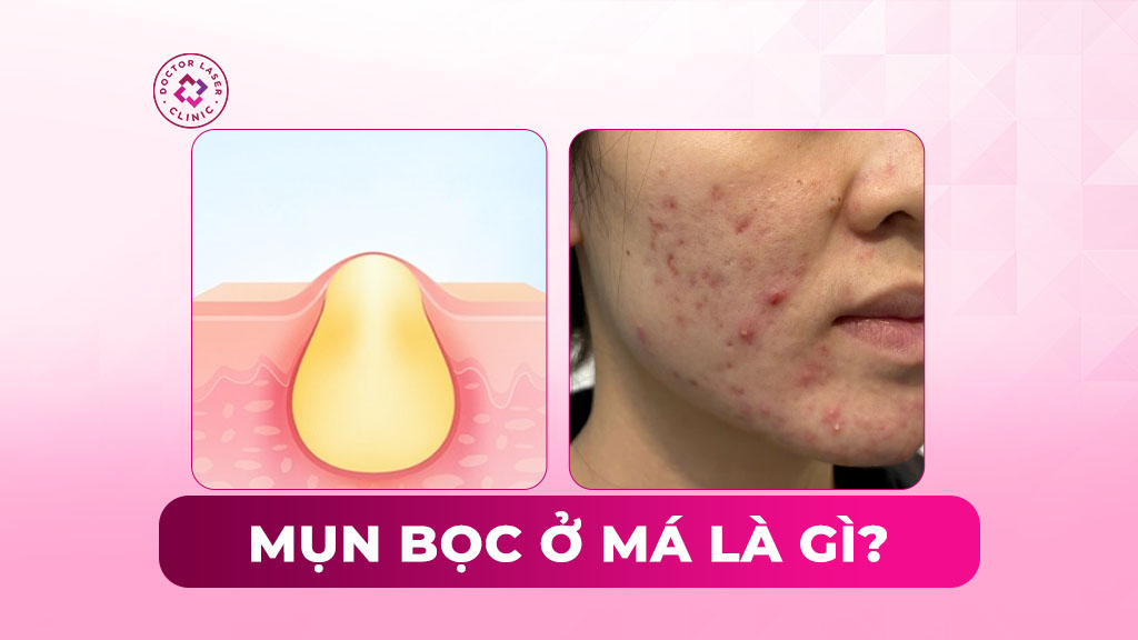mụn bọc ở má là gì