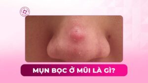 mụn bọc ở mũi là gì