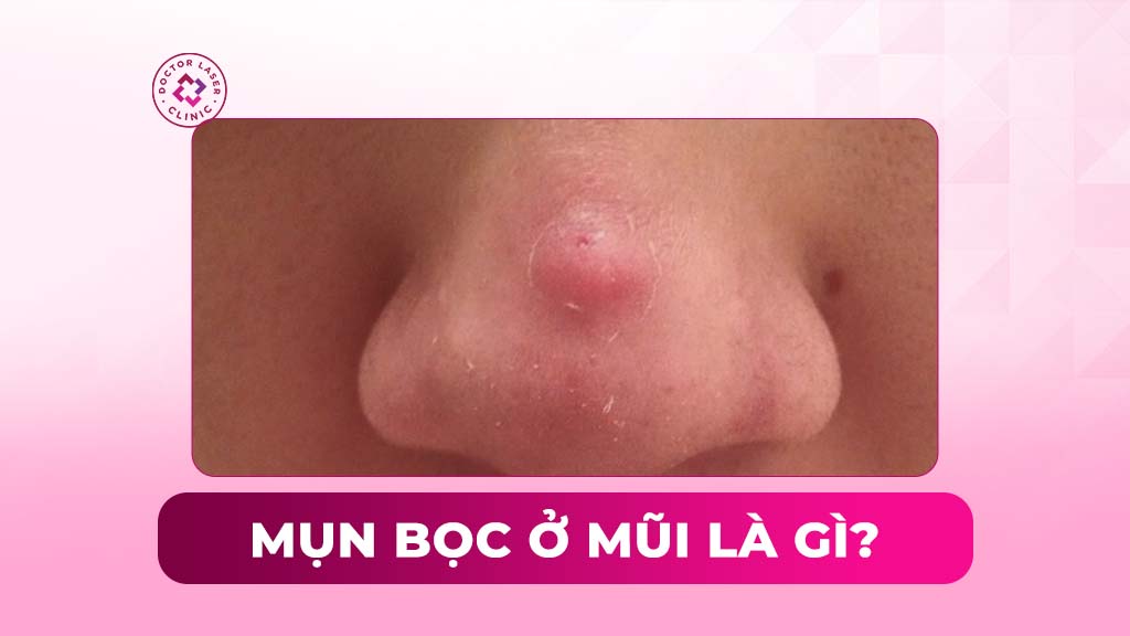 Mụn bọc ở mũi: Nguyên nhân, dấu hiệu và cách điều trị