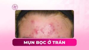 mụn bọc ở trán