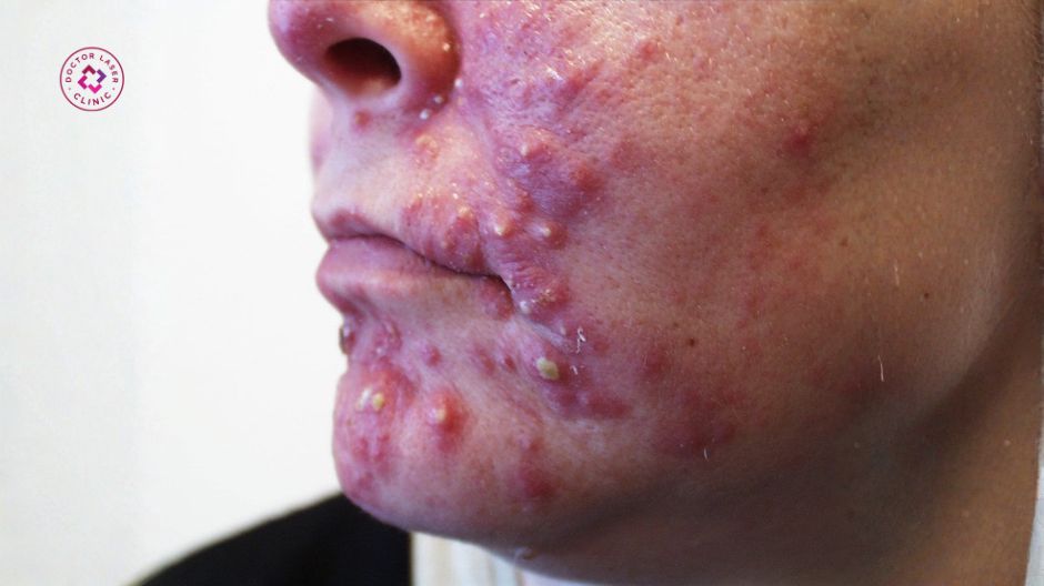 mụn nang mụn viêm nặng