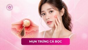 mụn trứng cá bọc