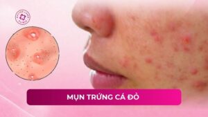 mụn trứng cá đỏ