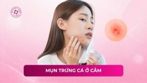 mụn trứng cá ở cằm