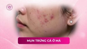 mụn trứng cá ở má