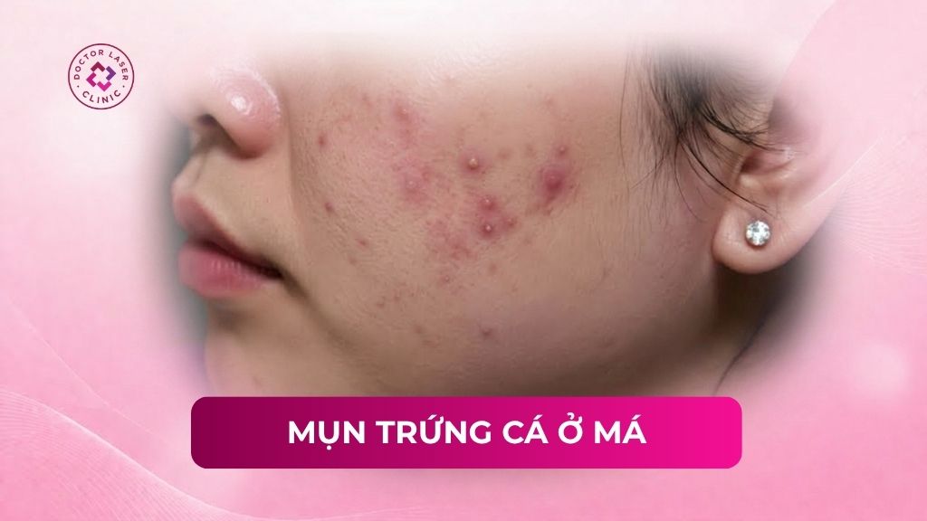 Mụn trứng cá ở má: Nguyên nhân, cách điều trị và phòng ngừa 