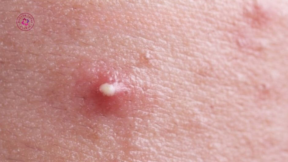 mụn viêm có mủ