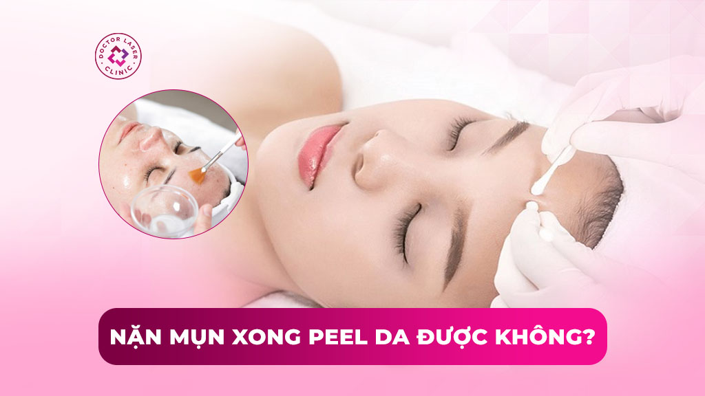 Nặn mụn xong peel da được không? Thời điểm nào an toàn? 