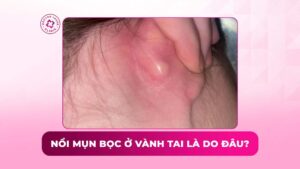 nổi mụn bọc ở vành tai là do đâu