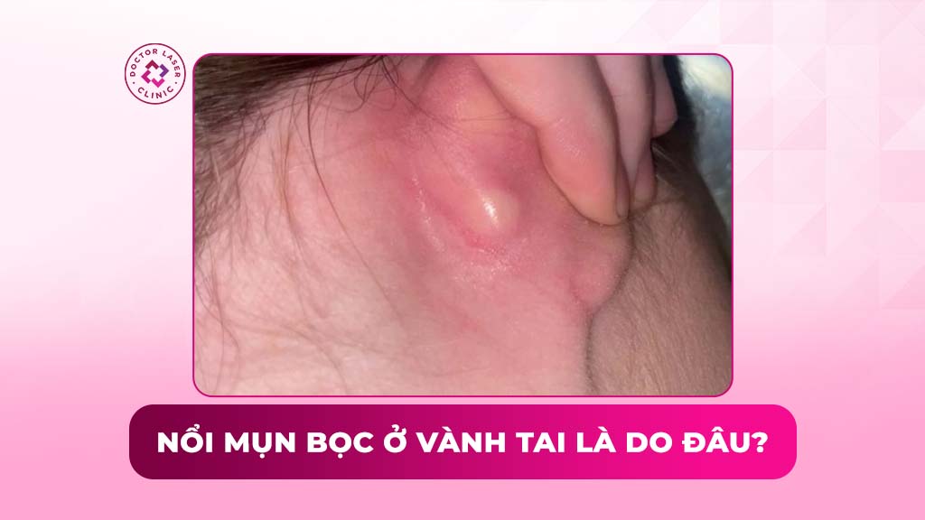 Nổi mụn bọc ở vành tai là do đâu? Hướng dẫn cách điều trị