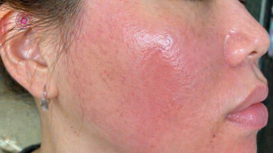 peel da bị sưng mặt dấu hiệu bình thường