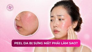 peel da bị sưng mặt phải làm sao