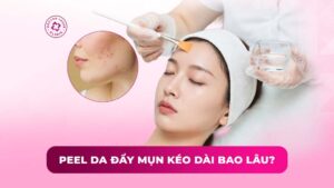 peel da đẩy mụn kéo dài bao lâu