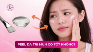 peel da trị mụn có tốt không