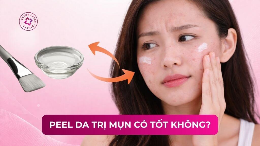 Peel da trị mụn có tốt không? Ưu nhược điểm và quy trình thực hiện