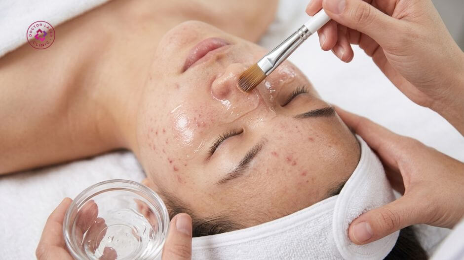 peel da trị mụn là gì