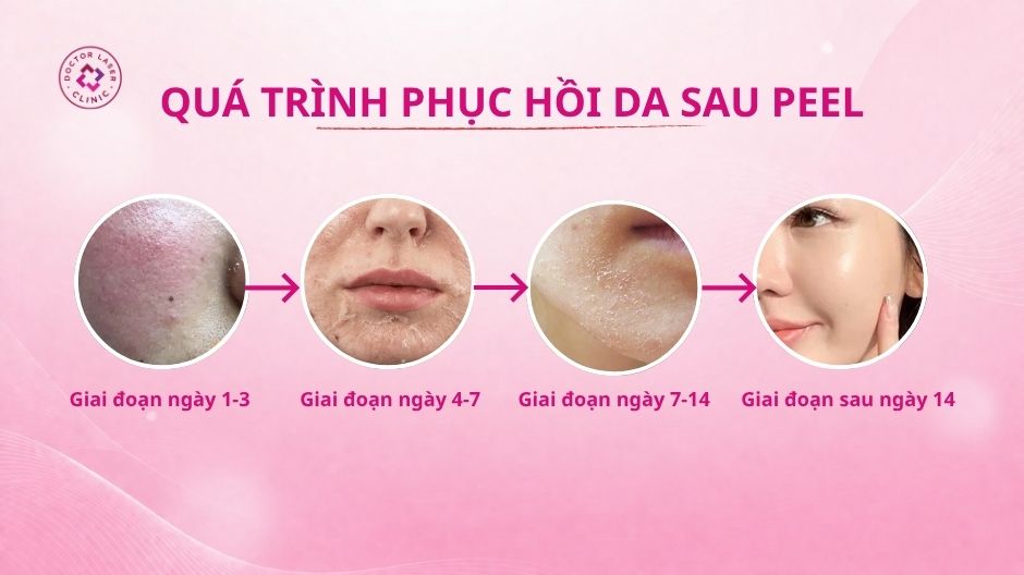 quá trình phục hồi da sau peel