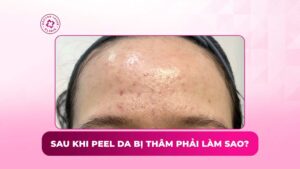 sau khi peel da bị thâm phải làm sao