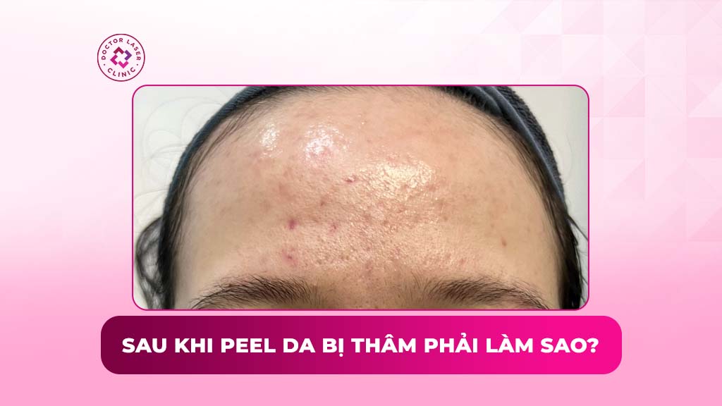 sau khi peel da bị thâm phải làm sao