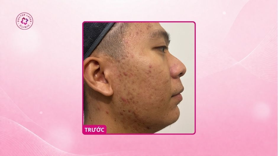 sẹo rỗ má thái dương trước điều trị laser co2