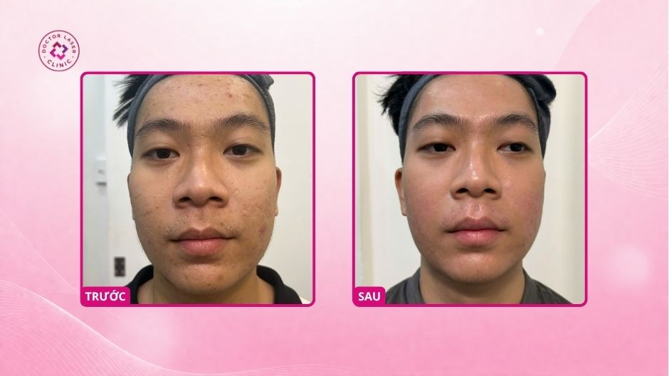 sẹo rỗ má thái dương trước sau laser co2 fractional